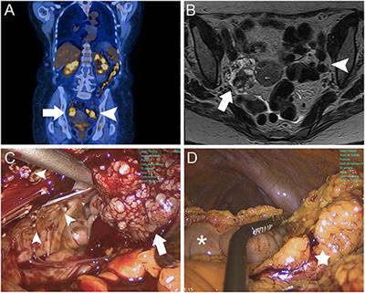 Transvaginal Natural Orifice Transluminal Endoscopic Surgery for Surgical Staging of Early-Stage Ovarian Cancers: A Report of Two Cases